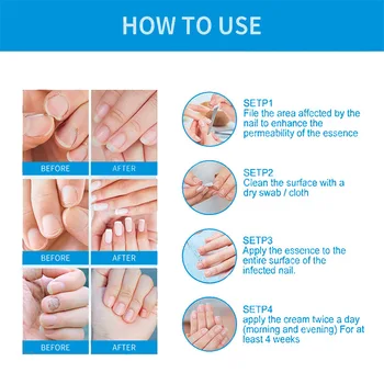 Лечение на гъбички на ноктите за нокти Ремонт на ноктите Онихомикоза на краката си Паронихия Противоинфекционная Течност за премахване на гъбички на ноктите на краката 5